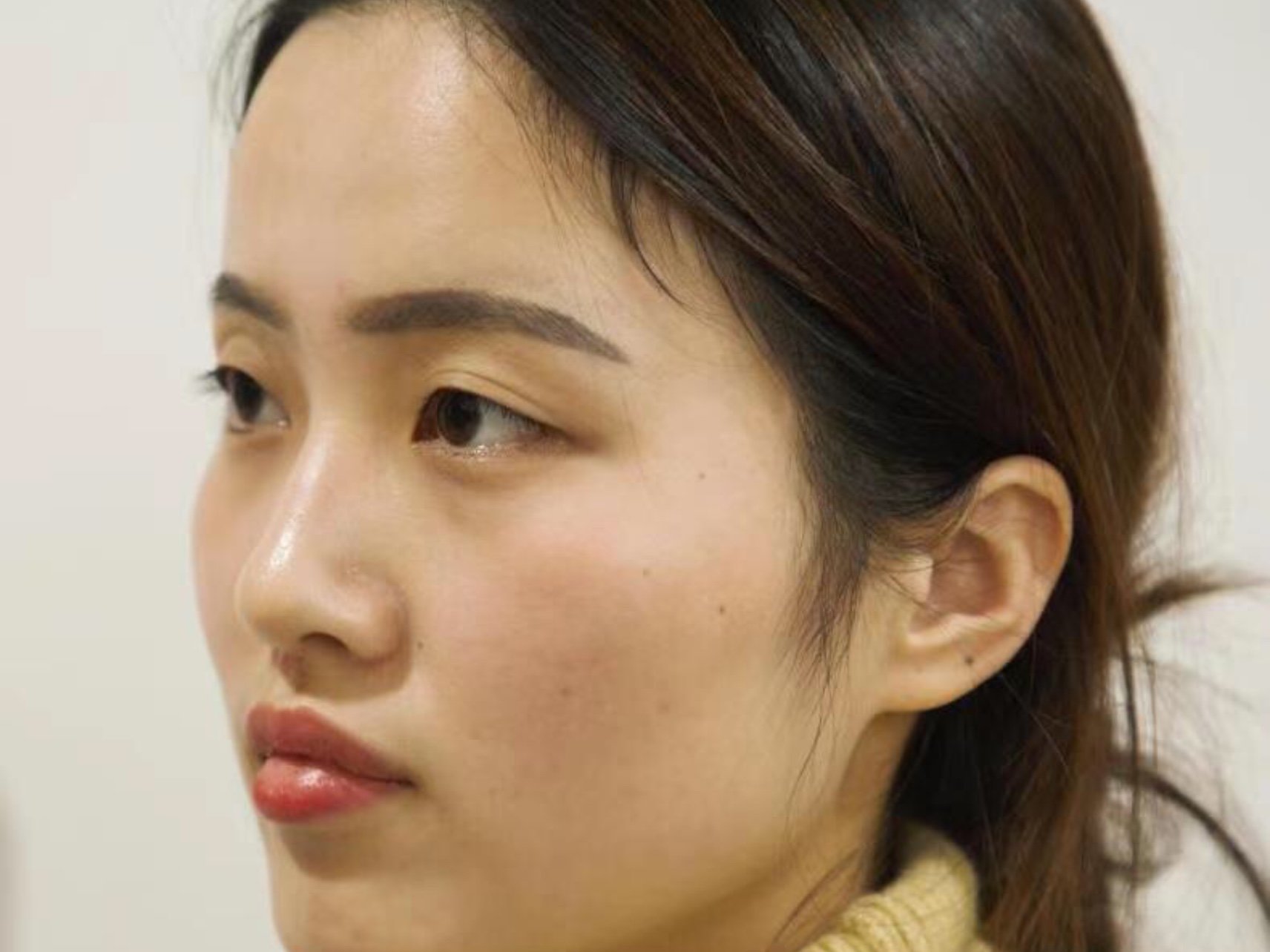 [:163]体验前变美诉求:我是单眼皮,眼窝凹陷,_圈子-新氧美容整形