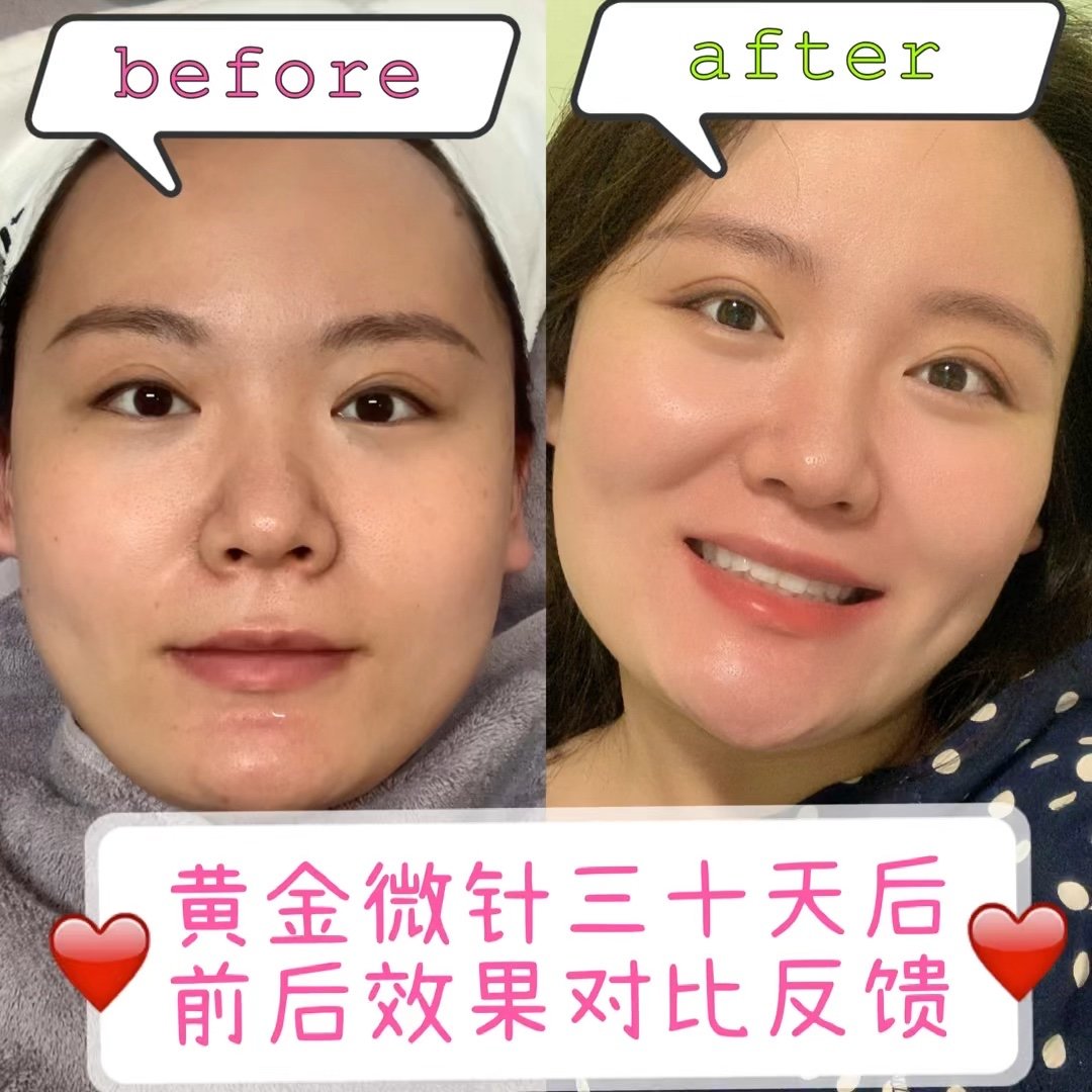 黄金微针77英诺小棕瓶第四期前后效果对比反馈来啦,改_圈子-新氧