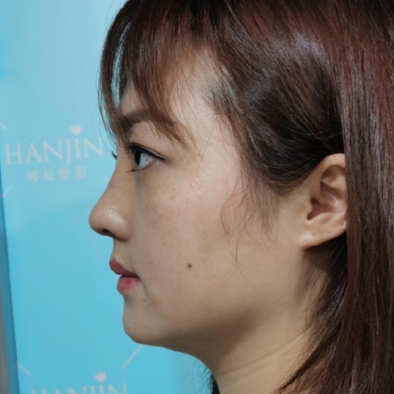 求美者术前鼻头后缩鼻背高度不够山根低