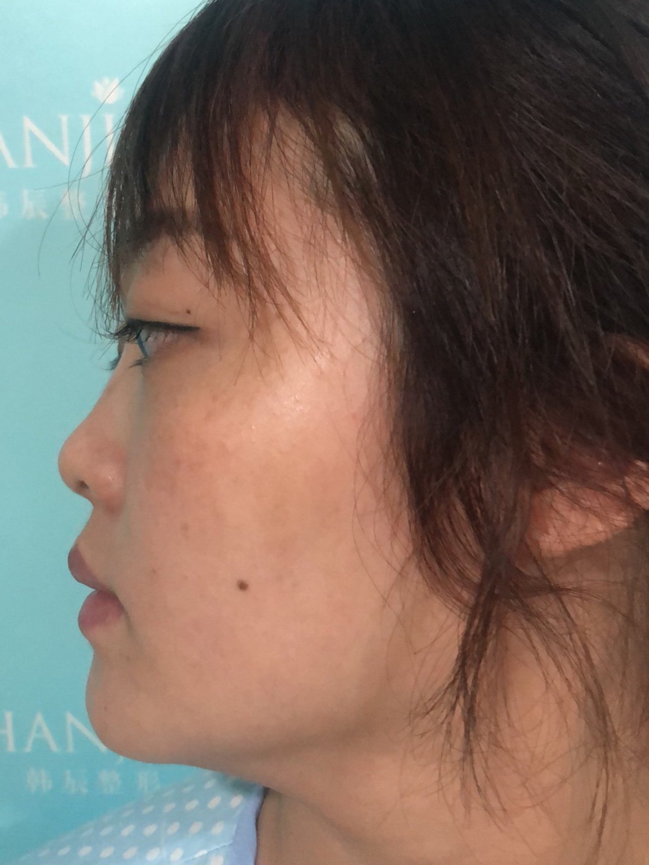 求美者术前鼻头后缩鼻背高度不够山根低