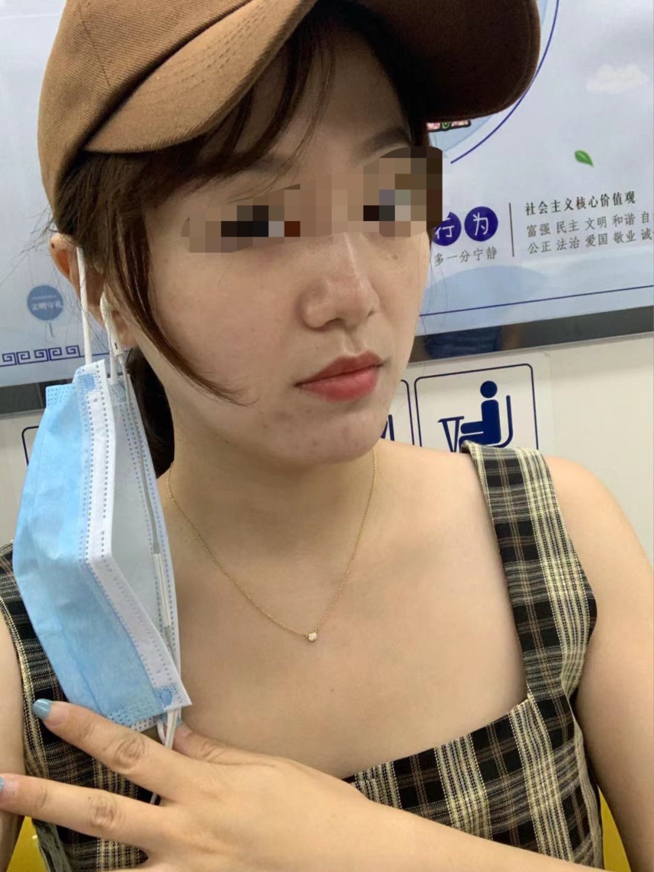 我做的是美国强生鱼骨线,面中下部,一共用了四根.