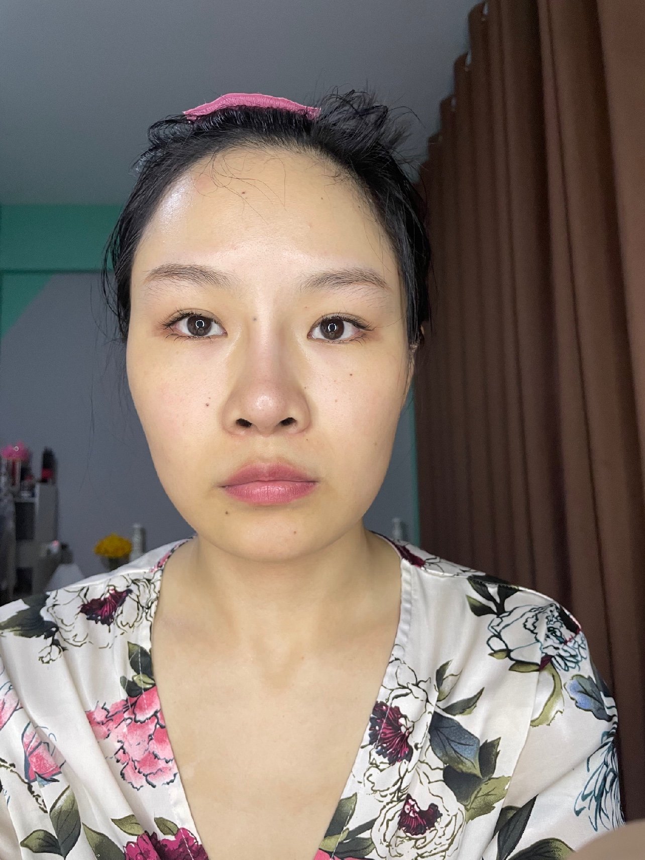 体验前变美诉求改善法令纹