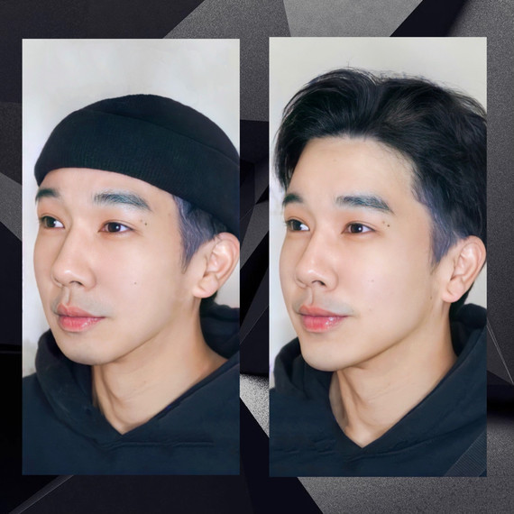 前几天终于带我的好兄弟去做了玻尿酸填充太阳穴和下巴_圈子-新氧美容