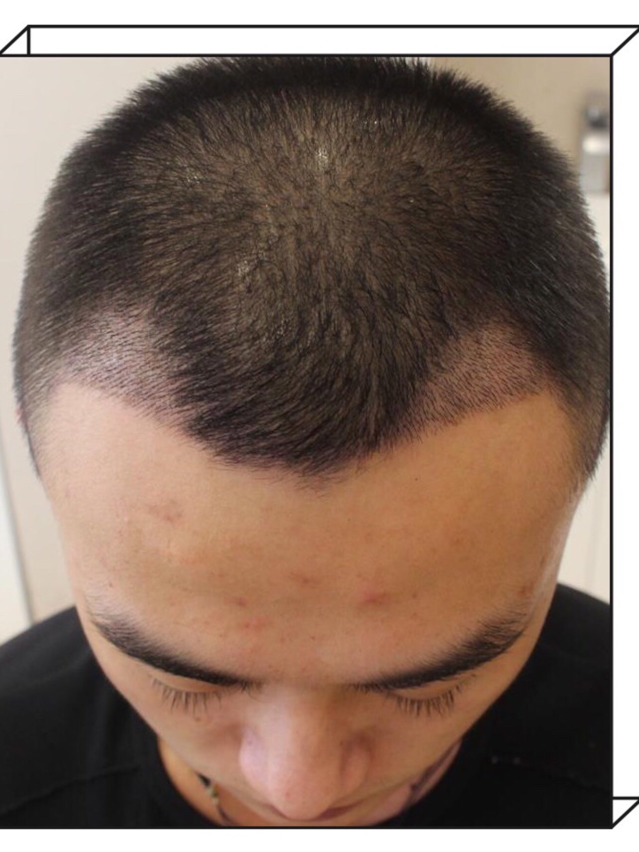 以前对头发的防脱意识太差了额角的两侧毛囊闭合的差不_圈子-新氧美容