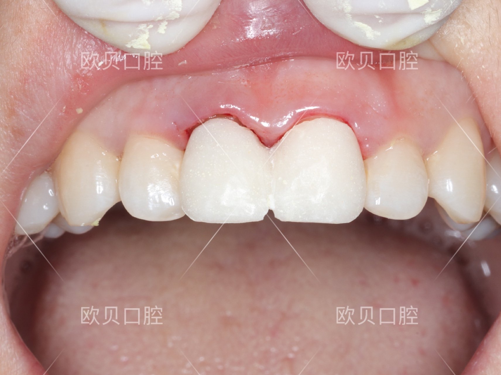 门牙全瓷牙冠图片图片