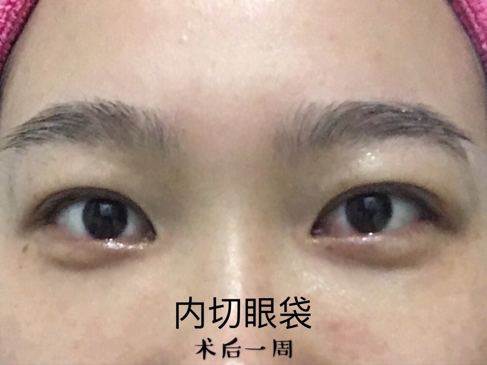 内切祛眼袋眶隔释放术后效果