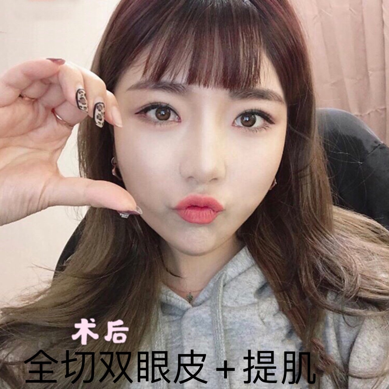 全切双眼皮提肌开内眼角术后效果