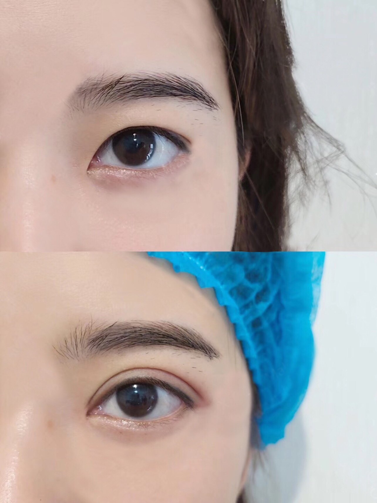 术前是内双眼皮,眼睛还是挺大的,做的是7mm平行双_圈子-新氧美容整形
