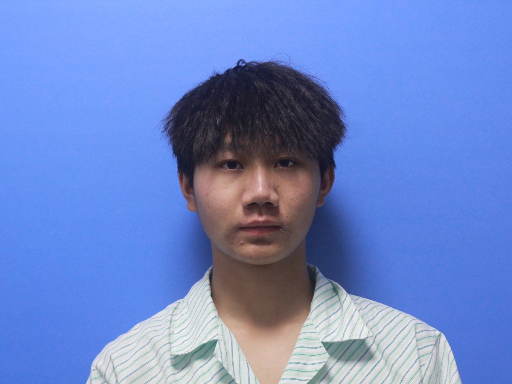 术前:大鼻头,低鼻,鼻头鼻翼肥大,鼻翼大小不一,鼻_圈子-新氧美容整形