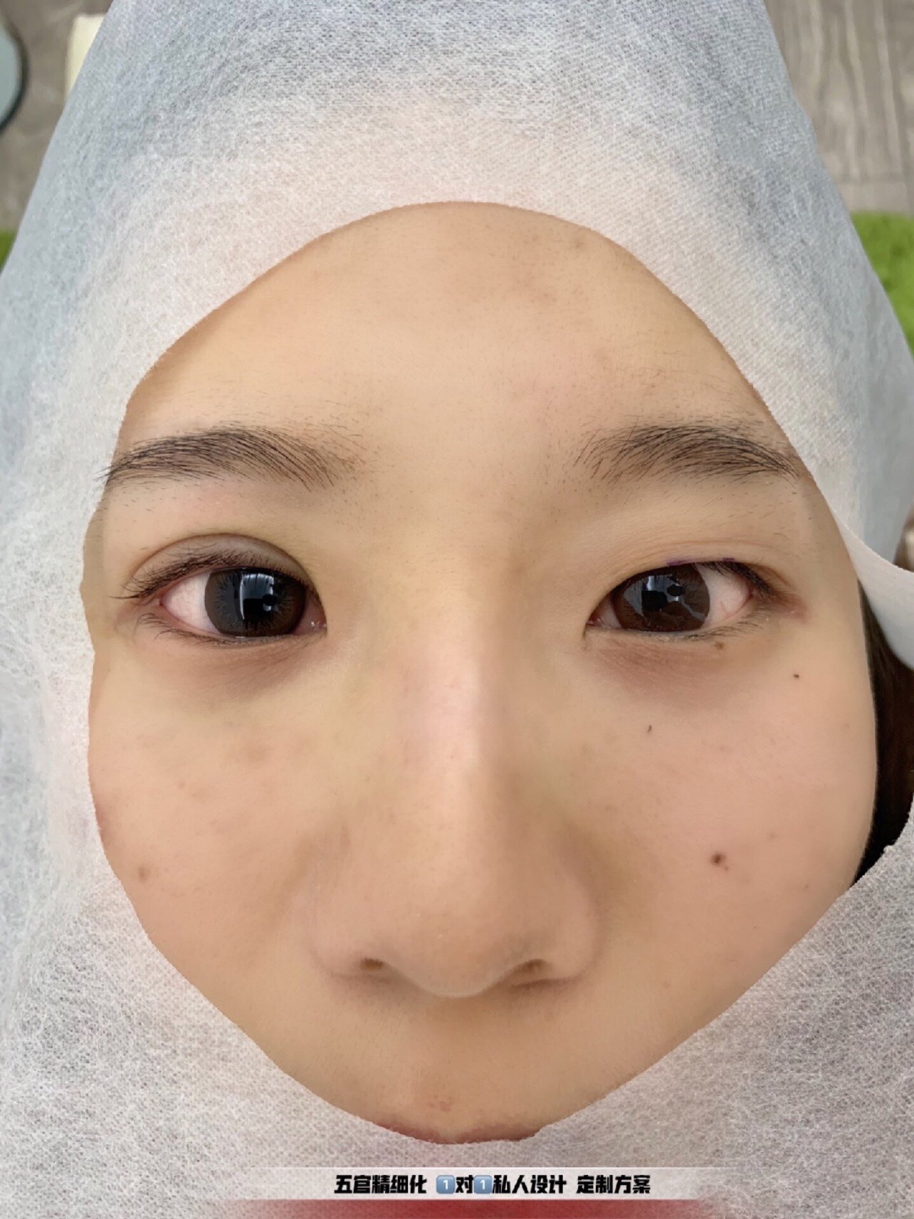 小姐姐术前单眼皮 大小眼 眼部多层眼皮松弛无力