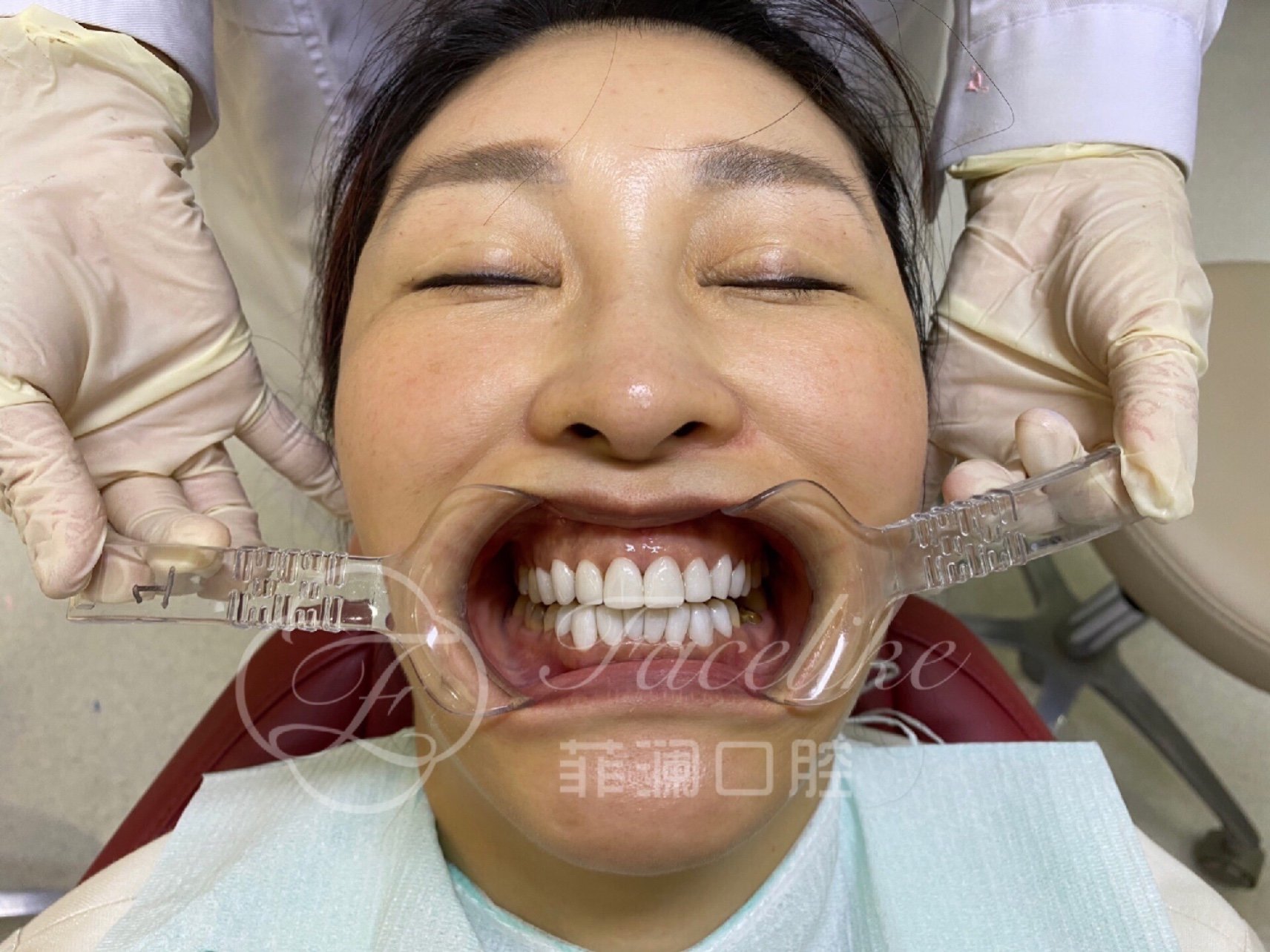 义获嘉铸瓷贴面07