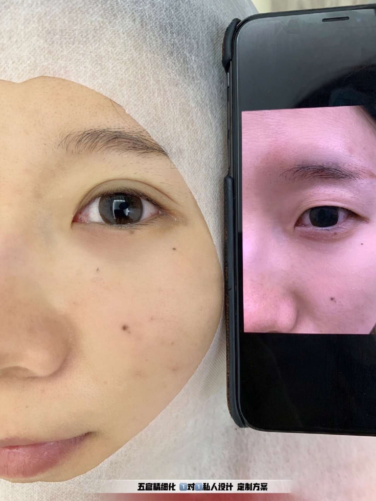 小姐姐术前单眼皮 大小眼 眼部多层眼皮松弛无力