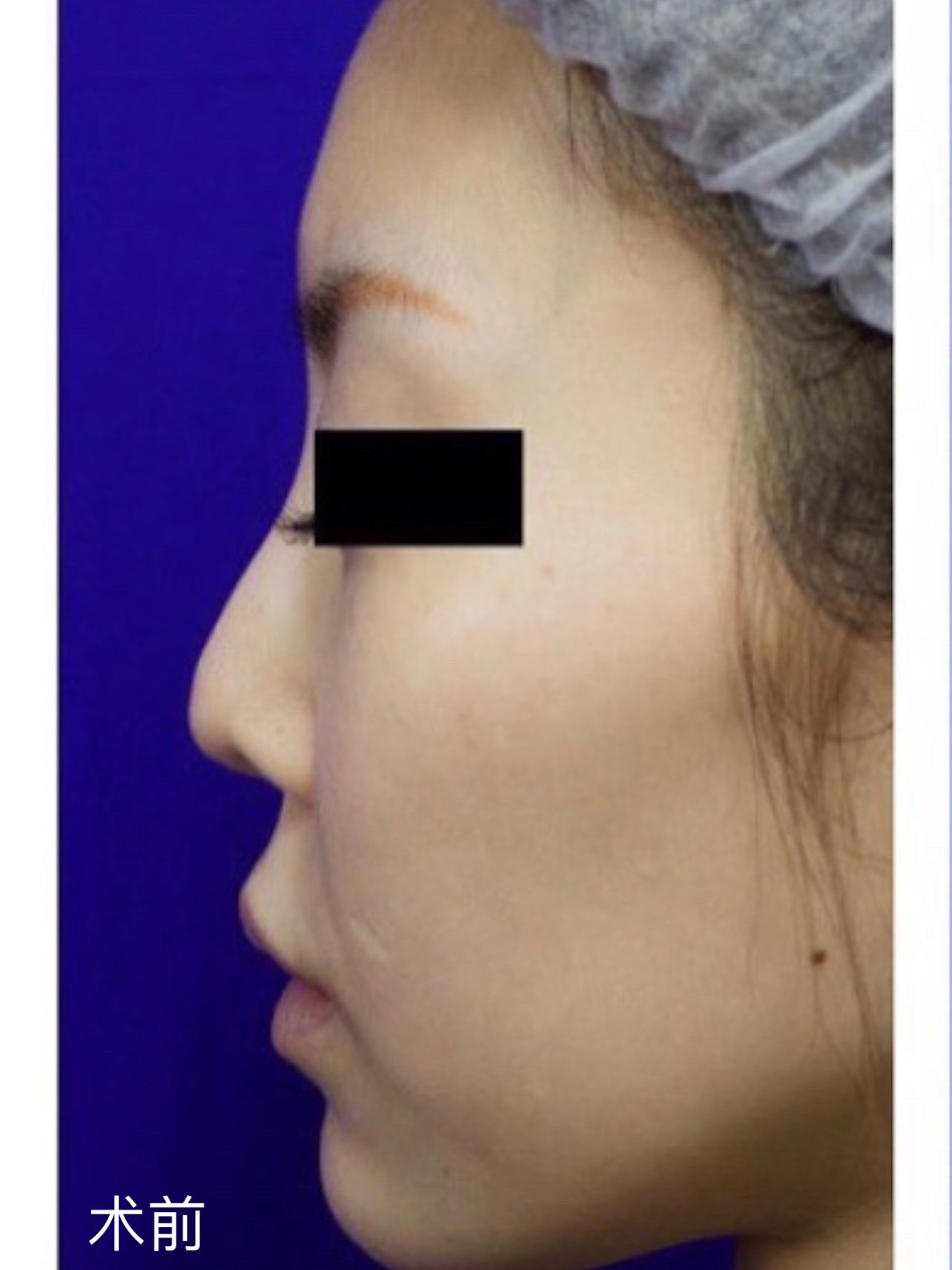 患者术前鼻尖比较塌,鼻小柱短