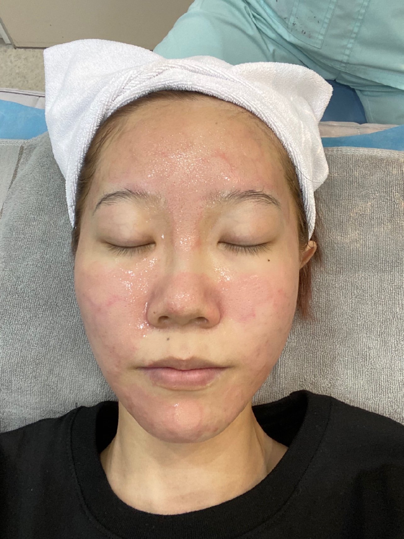 78m22点阵贝妮芙恢复第10天78点阵激光,专治毛孔_圈子-新氧美容