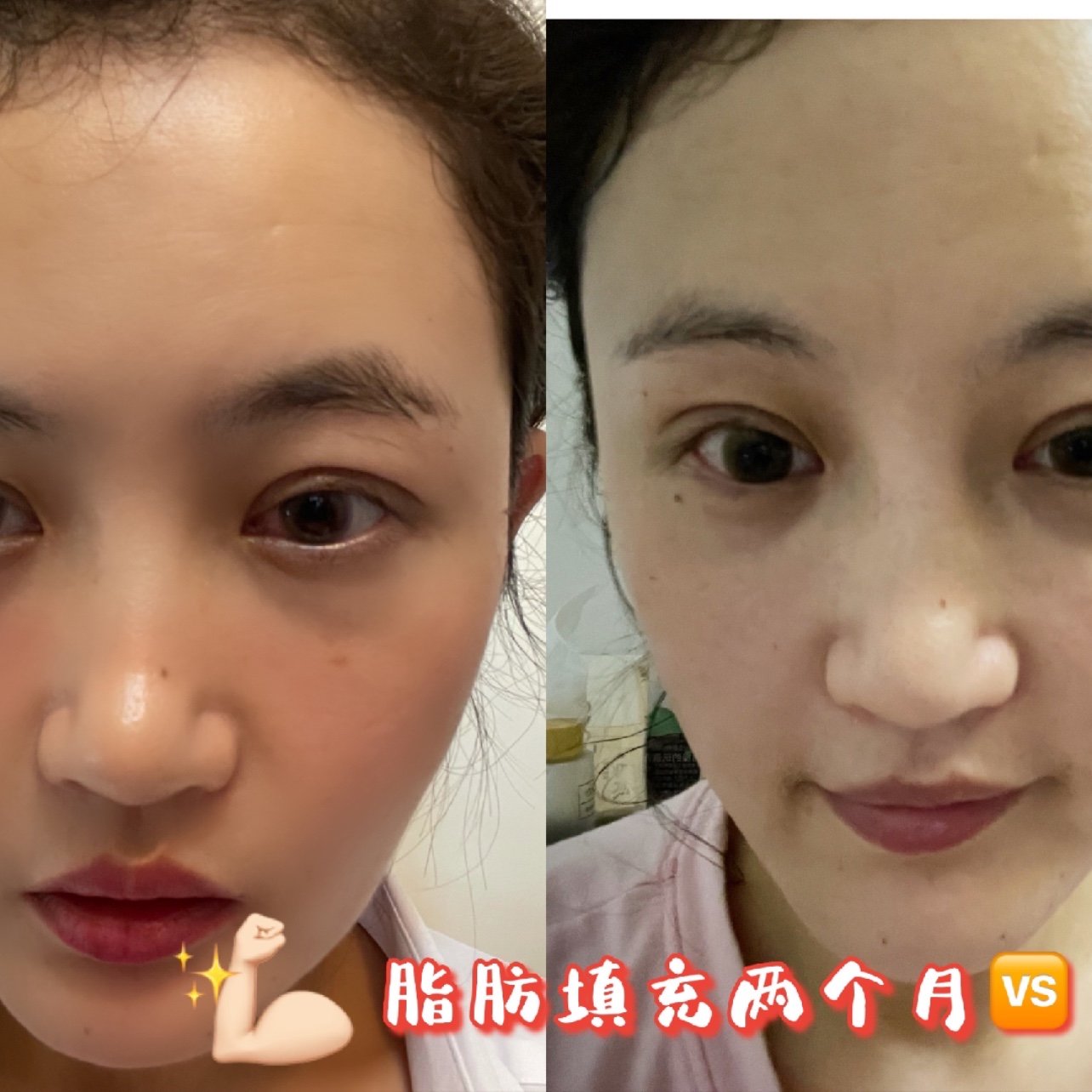 脂肪填充和双眼皮都已经两个月了