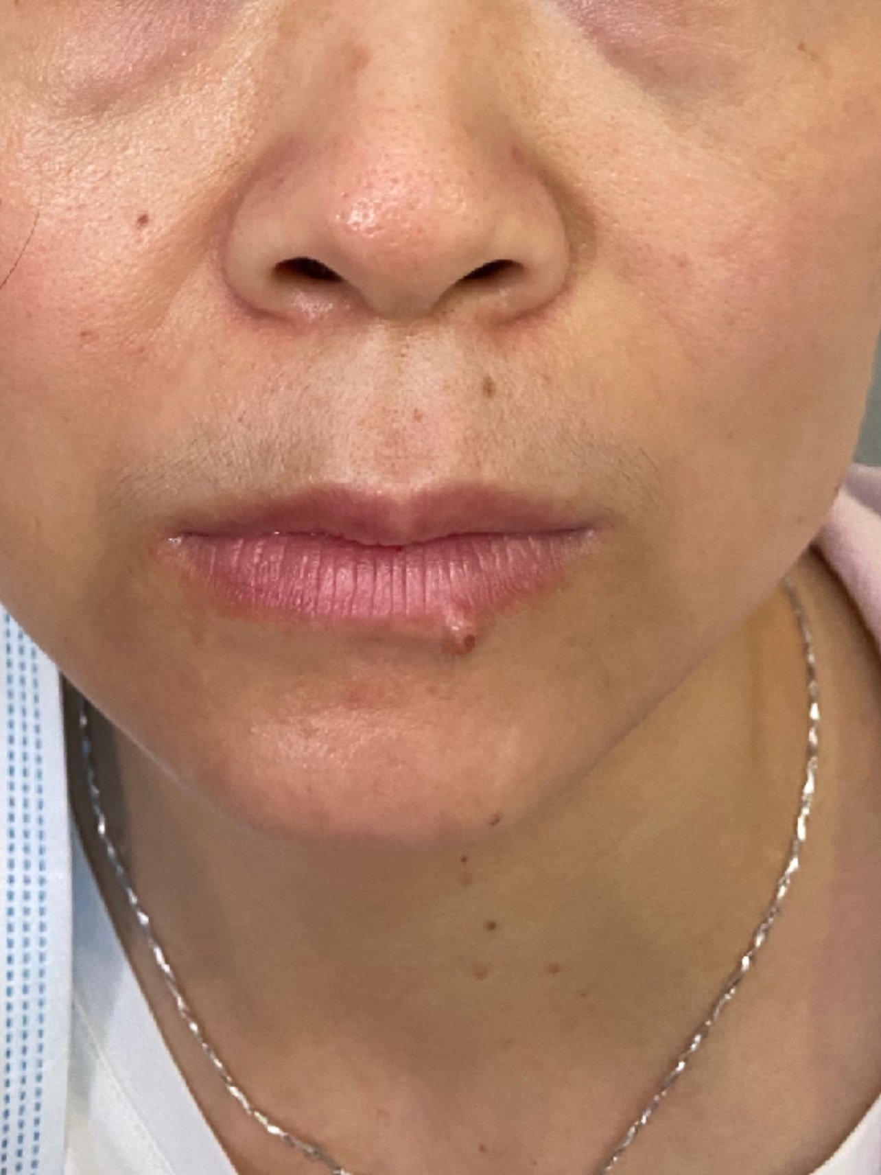 左侧嘴唇部复杂性肉痣