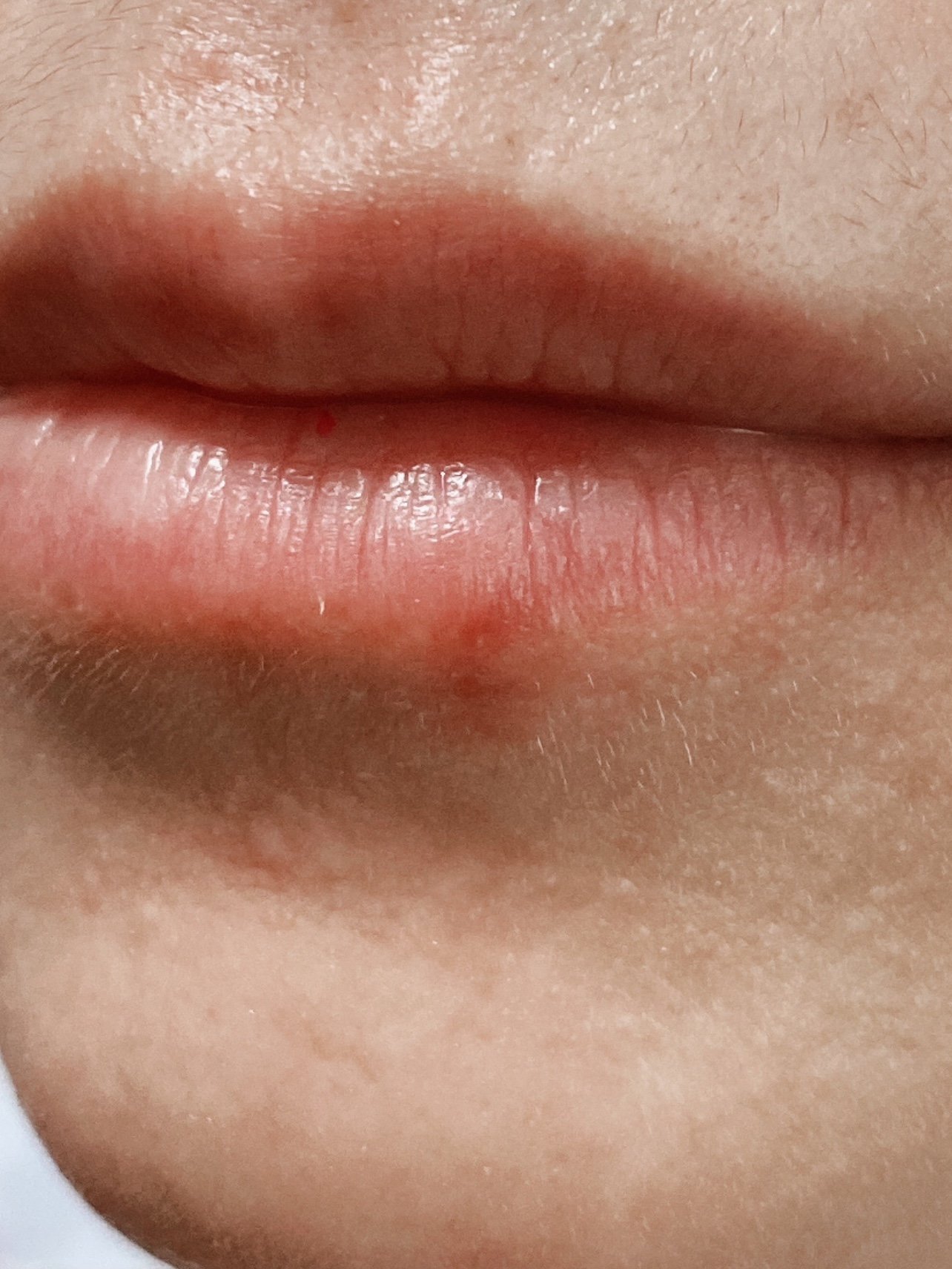 左侧嘴唇部复杂性肉痣