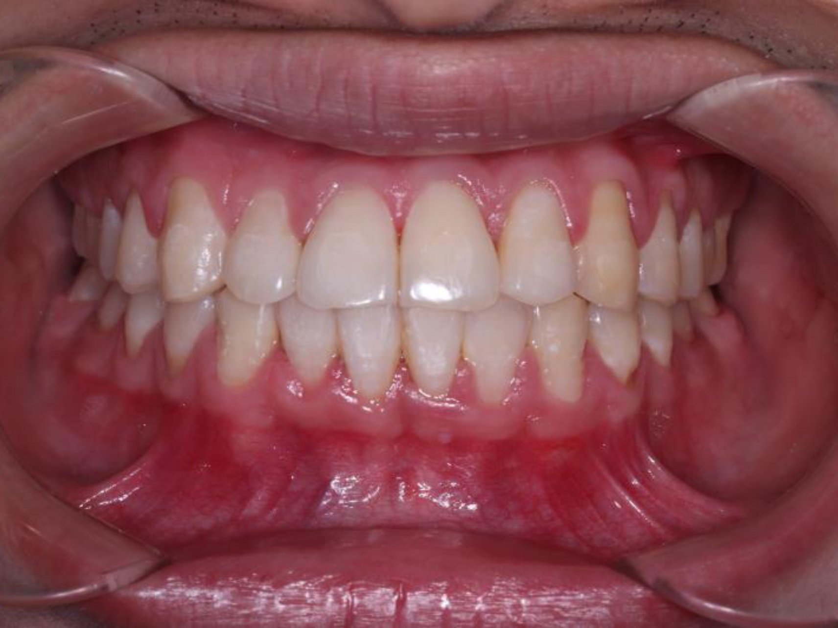 上牙突出,牙齿中线不对称,下牙牙齿畸形,不整齐咬合_圈子-新氧美容