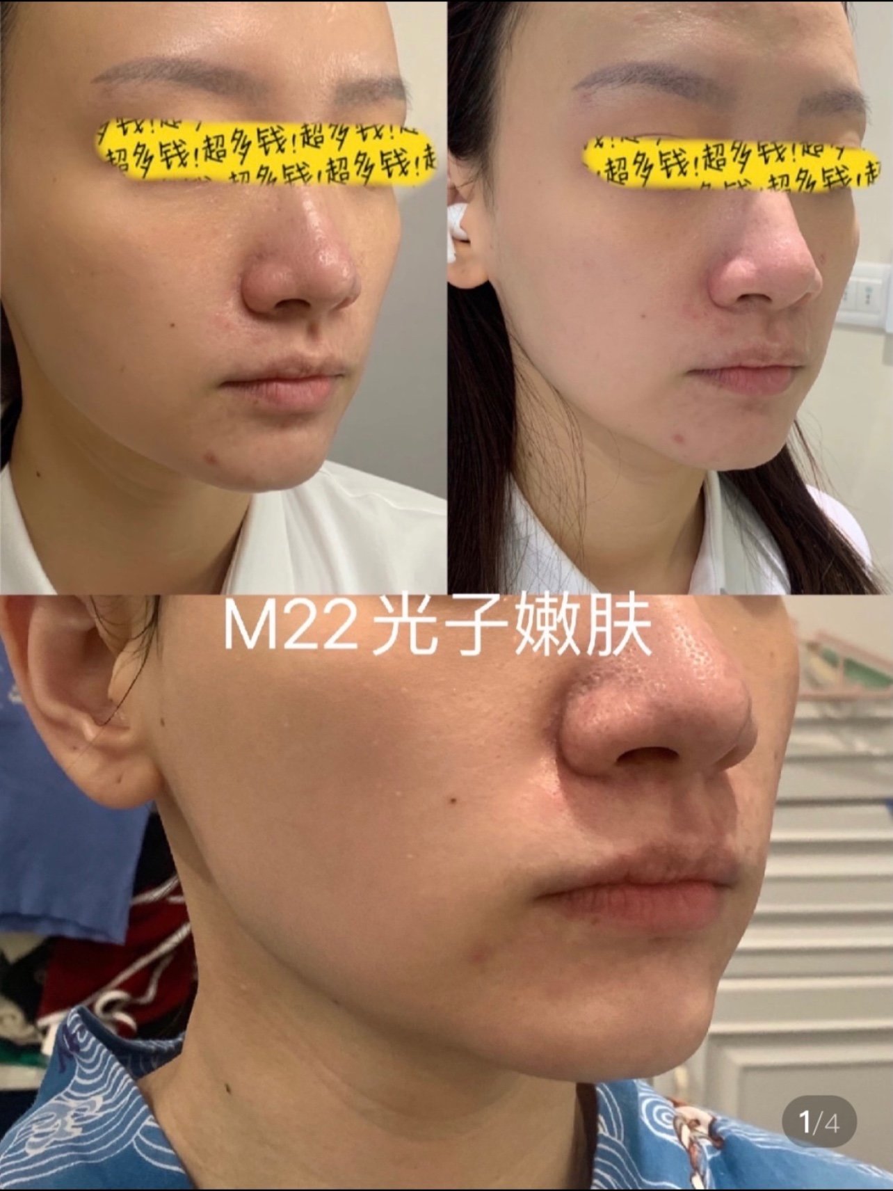 今天是m22光子嫩肤嫩肤模式祛斑模式的第二