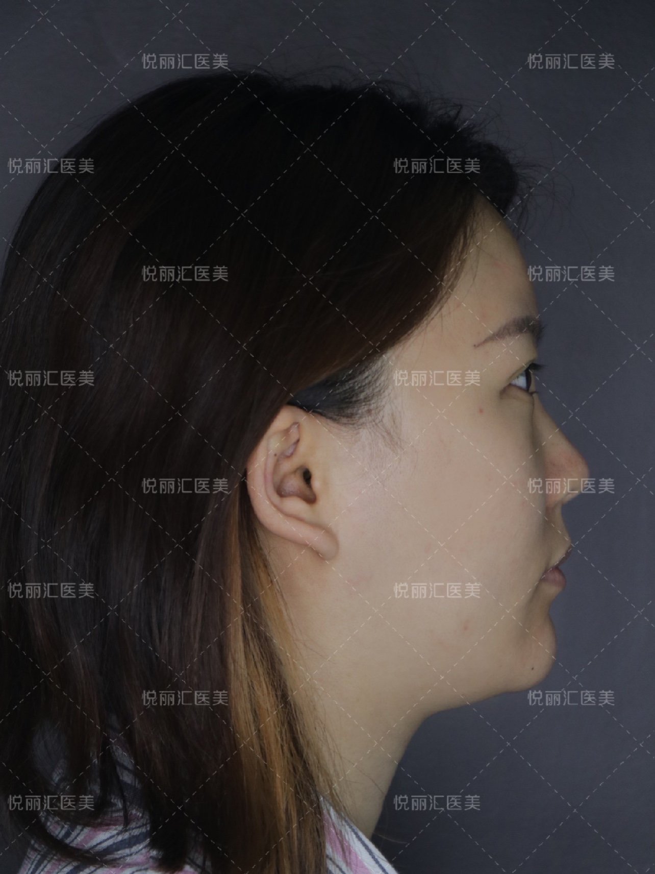 术前:短鼻,鞍鼻,鼻头圆钝,鼻基底凹陷,鼻小柱过短_圈子-新氧美容整形