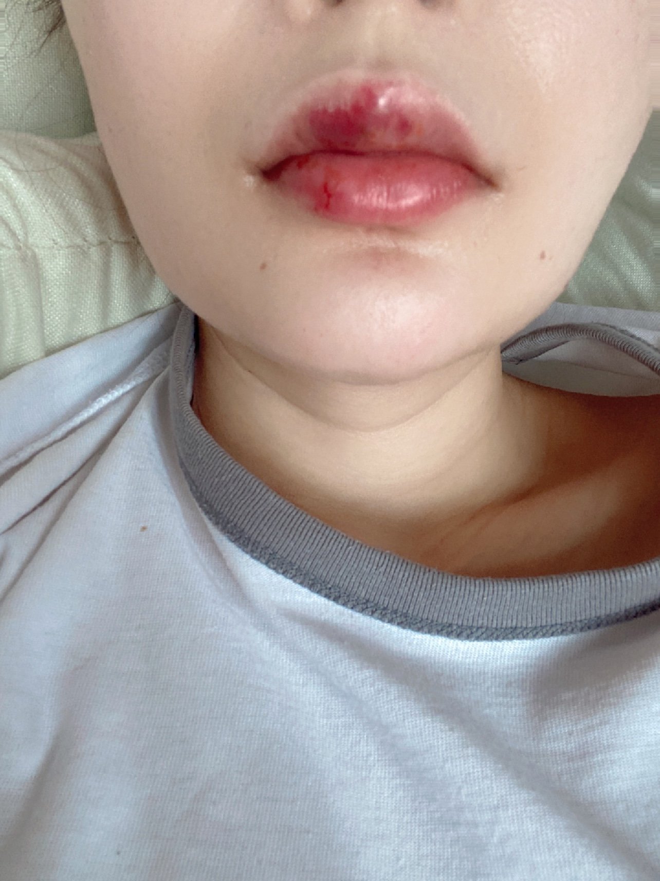体验前变美诉求:感觉嘴巴开始做牙齿矫正后,嘴唇就越来越薄,就想着打