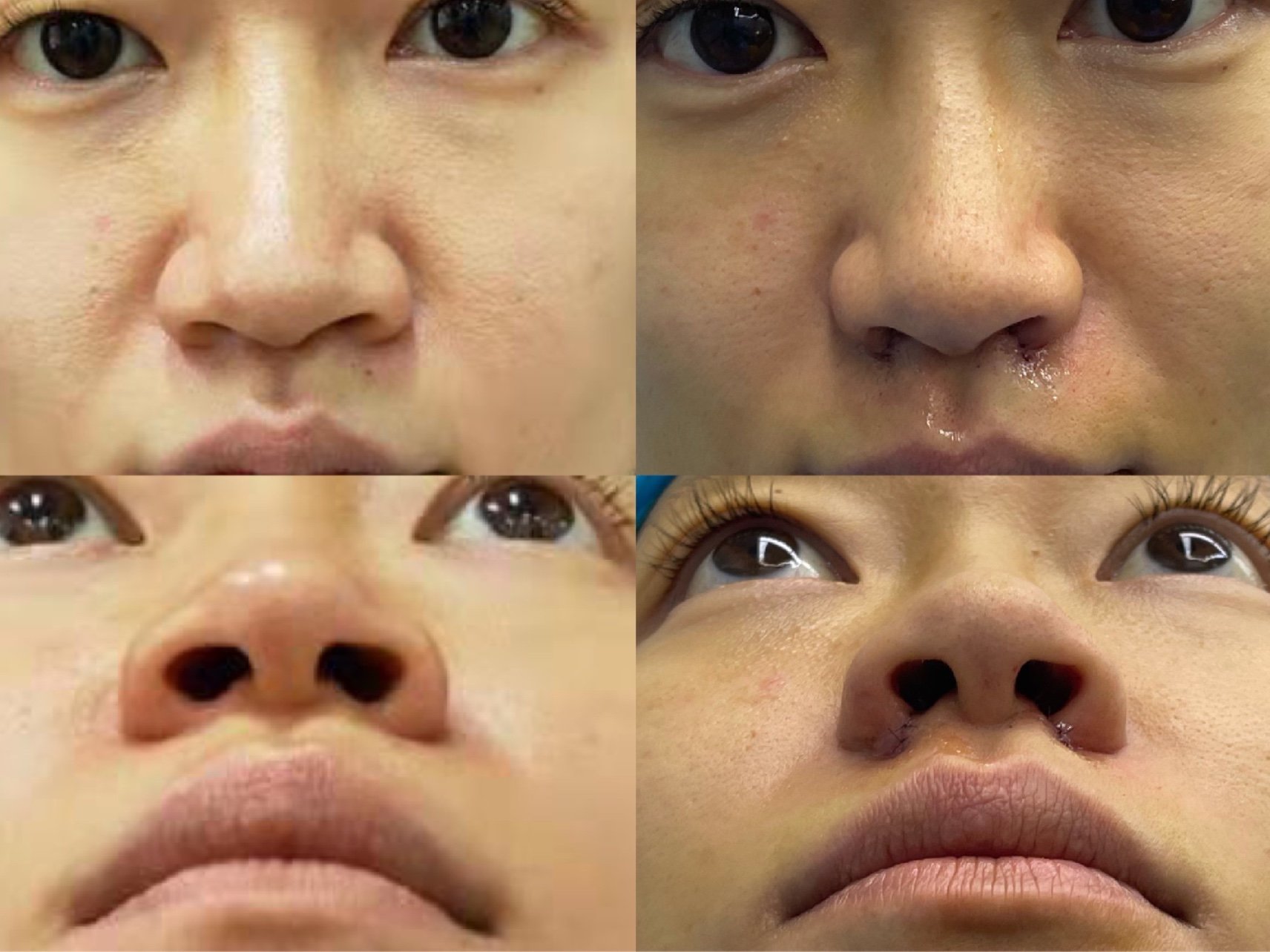 鼻翼肥大鼻孔外扩