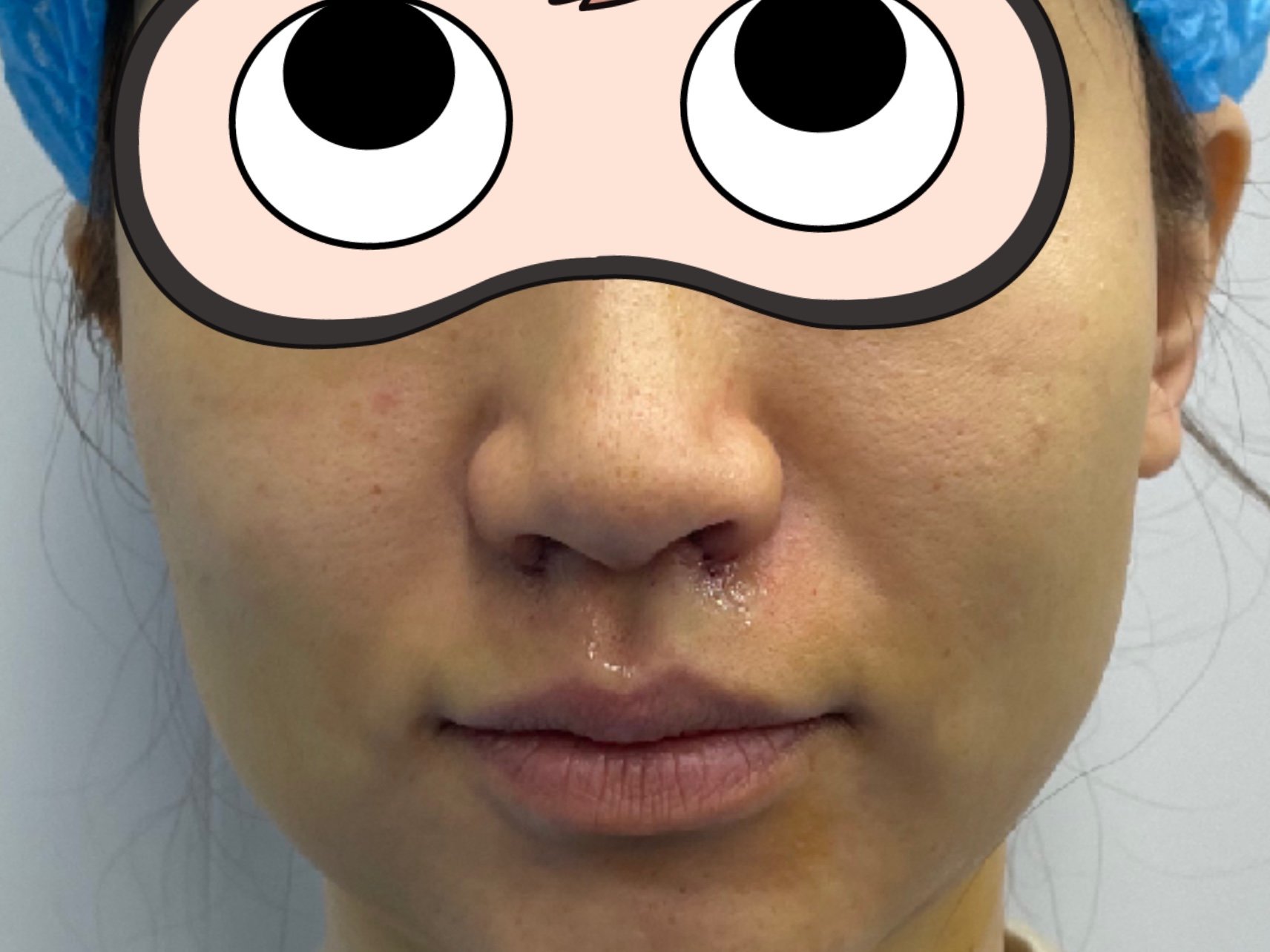 鼻翼肥大鼻孔外扩