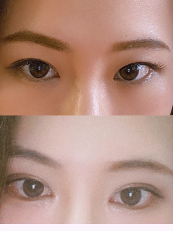 自然到亲妈都看不出来的"妈生眼"攻略分享内外眼角,_圈子-新氧美容