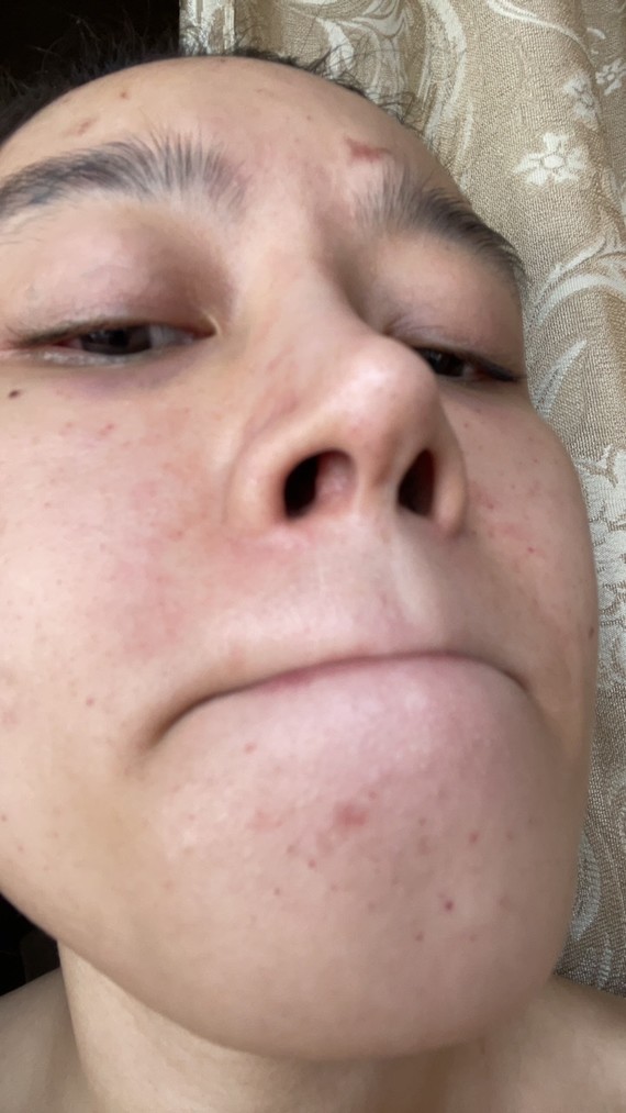 鼻假体发炎照片图片