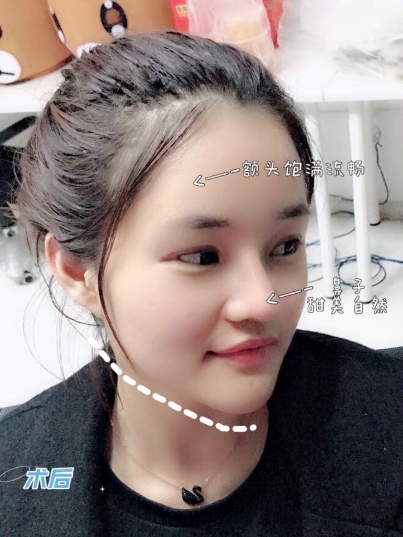 厚实鼻鼻头圆润隆鼻