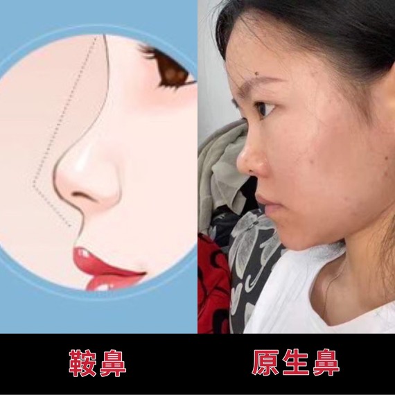 小姐姐的这种鼻子属于比较经典的马鞍鼻不光鼻头,鼻翼的肉感也是非常