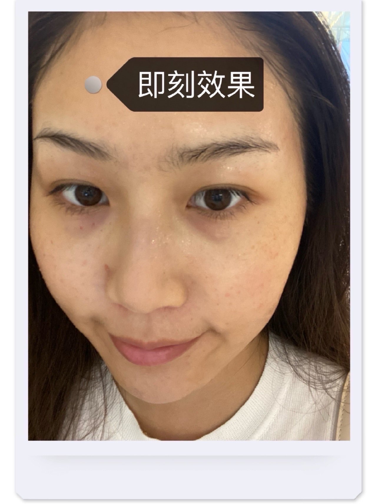 99本人肤质:我是夏天混油冬天大干皮,眼部周围容易长_圈子-新氧美容