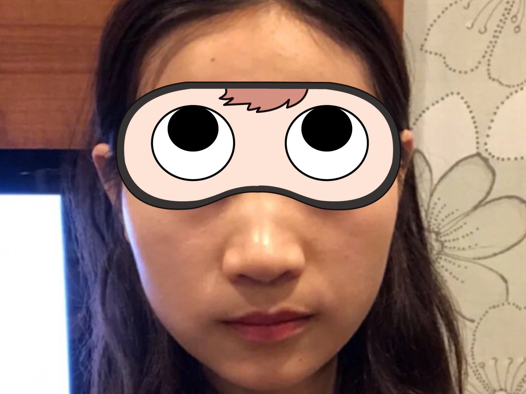 求美者术前存在矮鼻塌鼻宽鼻鼻翼肥大山根低