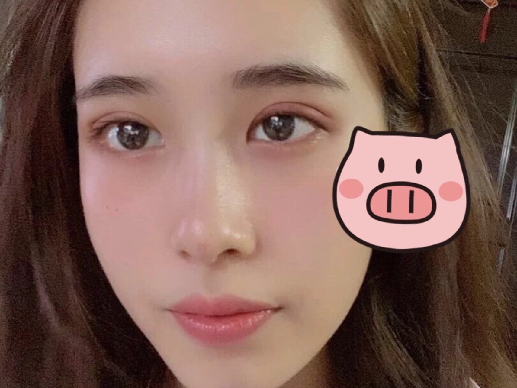 [:163]体验前变美诉求:一直以来都是单眼皮,贴_圈子-新氧美容整形