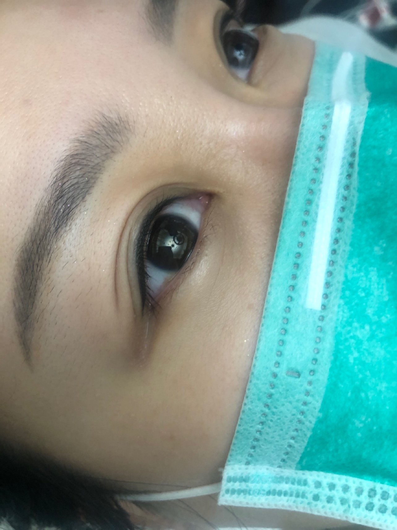 美瞳线已经做完美瞳线很久了,很不巧,眼睛"中招"_圈子-新氧美容整形