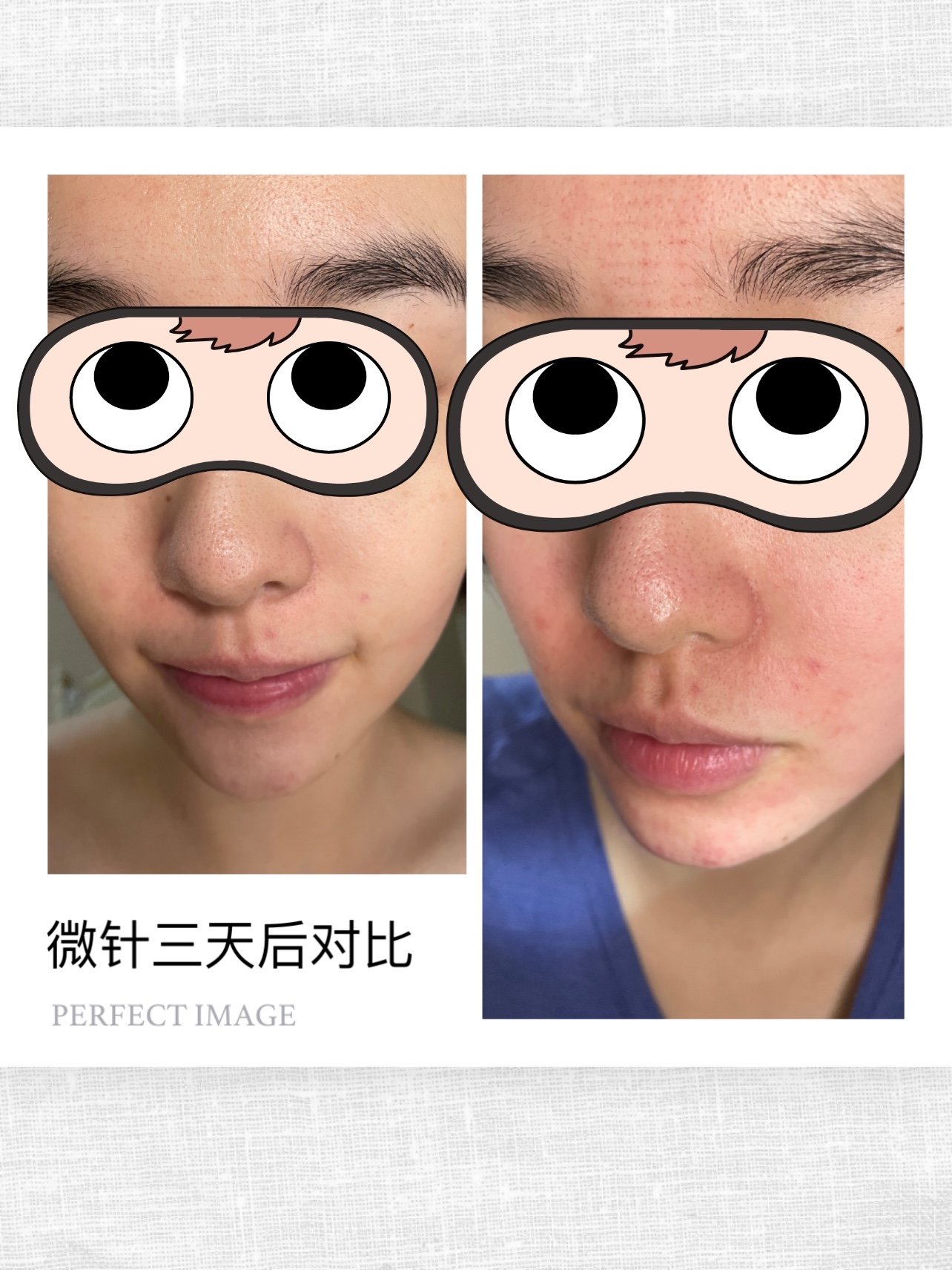 020202伊肤泉祛痘微针第三天