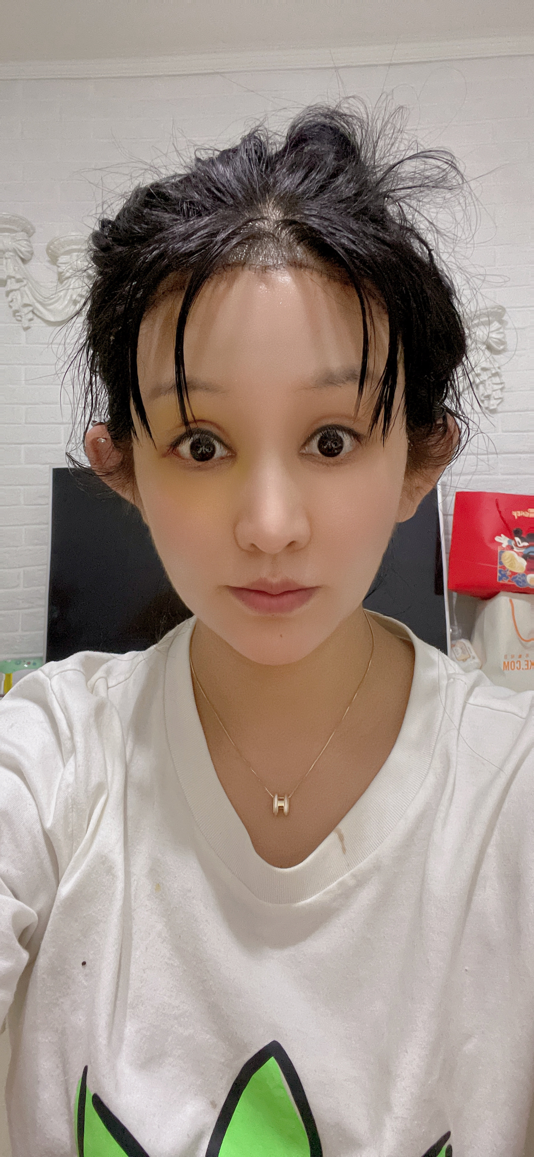 精灵耳第86615啦,还有两天就可以拆线_圈子-新氧美容整形