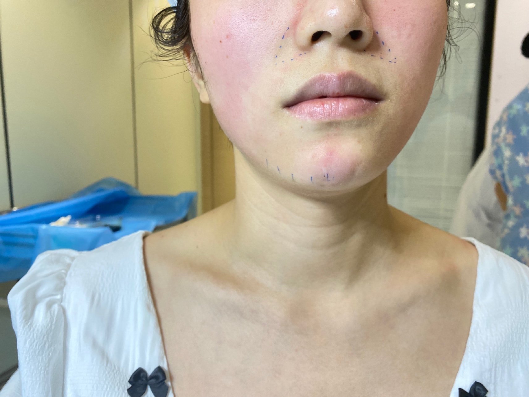 体验前变美诉求:下巴有点短,法令纹有点深