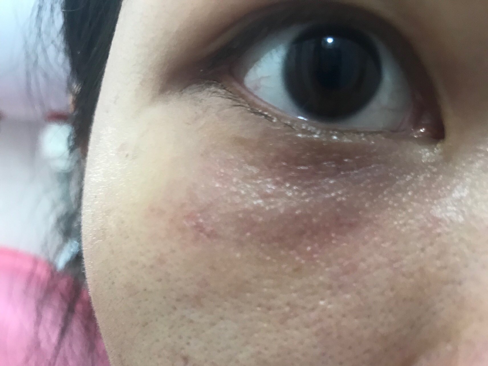 眼部有汗管瘤,脂肪粒,打得时候有点疼,肿了4天.恢_圈子-新氧美容整形