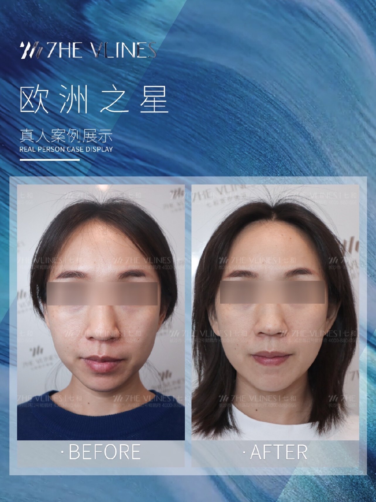 长沙七和欧洲之星术后即刻效果对比