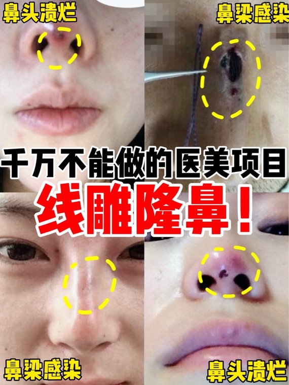 线雕隆鼻的广告宣传说:不用动刀就能改变塌鼻子9199,带给你高挺美