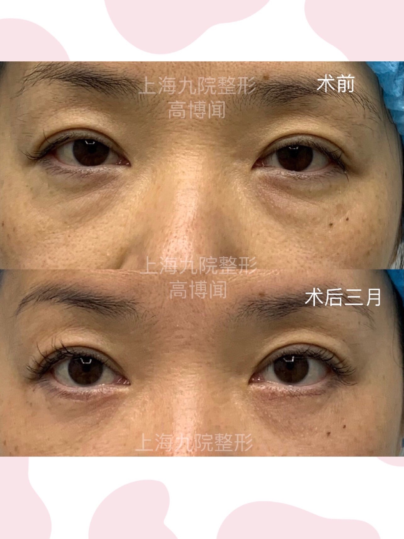 外切祛眼袋眶隔释放手术中面部提升术后效果