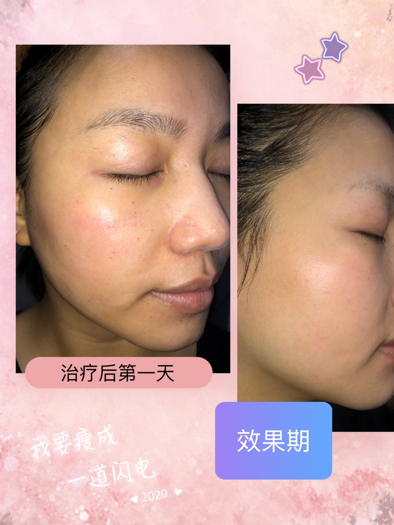 黄金微针 英诺小棕瓶联合治疗的术后18天恢复反馈!