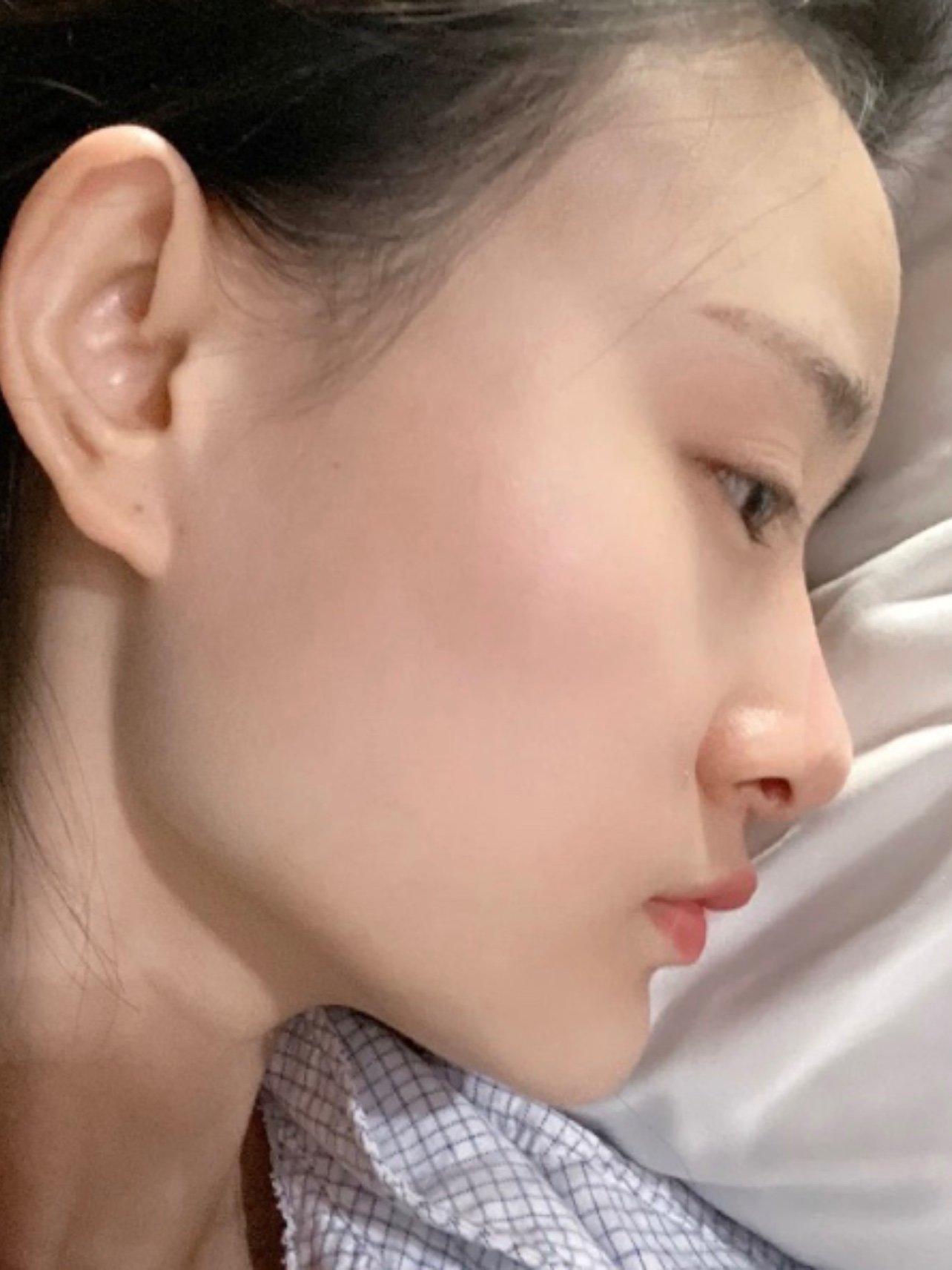 削下颌角三个月花费五w,我妈都说值了!