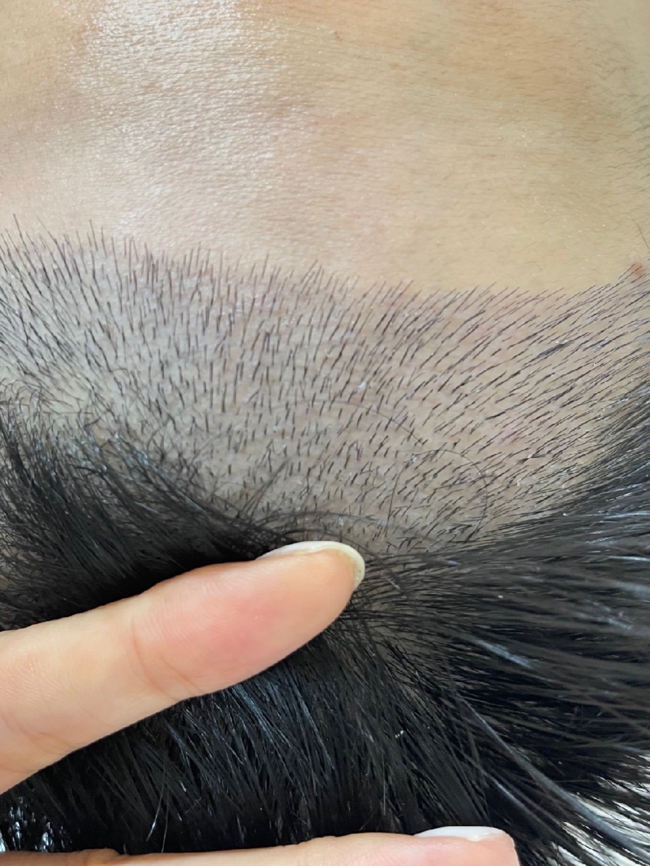 植发后…第一61来次69医61清院69理血痂.