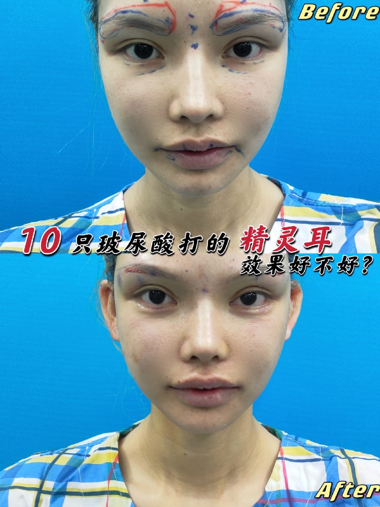 玻尿酸丰精灵耳所用产品:婕尔玻尿酸10只98_圈子-新氧美容整形