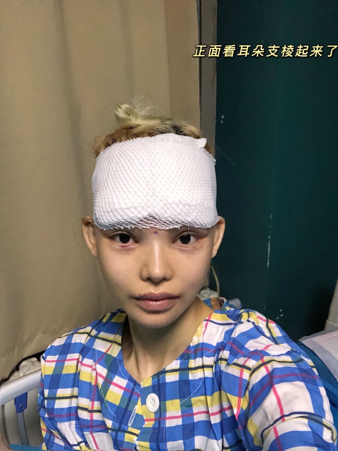 玻尿酸丰精灵耳所用产品:婕尔玻尿酸10只98_圈子-新氧美容整形