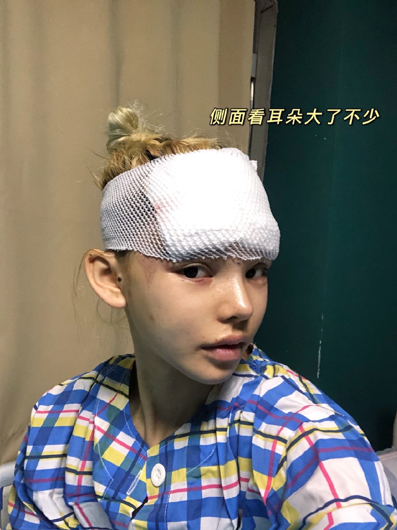 玻尿酸丰精灵耳所用产品:婕尔玻尿酸10只98_圈子-新氧美容整形