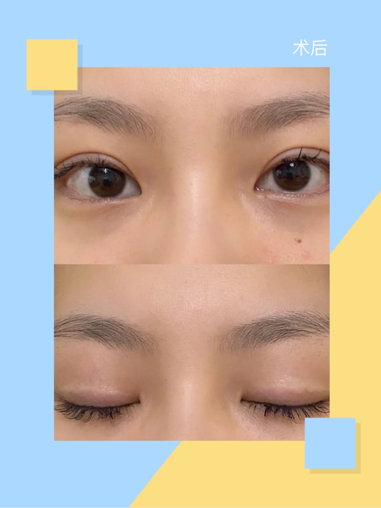 体验后效果:开扇型双眼皮7mm