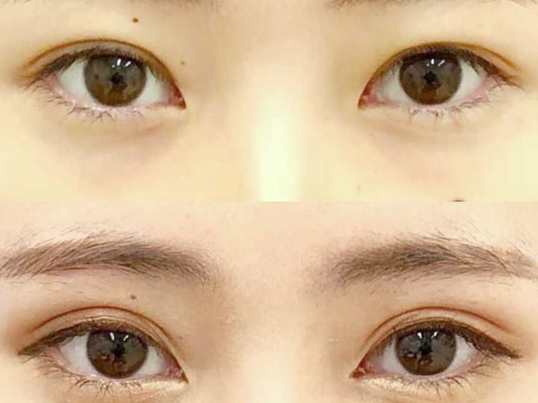 【关于双眼皮】:我的原生双眼皮非常窄,眼皮垂还有点_圈子-新氧美容